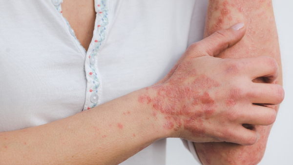 stress-and-psoriasis stress-and-psoriasis
