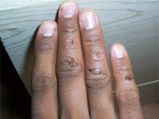ಸುಟ್ಟ ಗಾಯವಾದರೆ ತಕ್ಷಣ ಈ ರೀತಿ ಮಾಡಿ