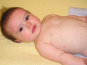 Relieve From Chicken Pox Itching Relieve From Chicken Pox Itching