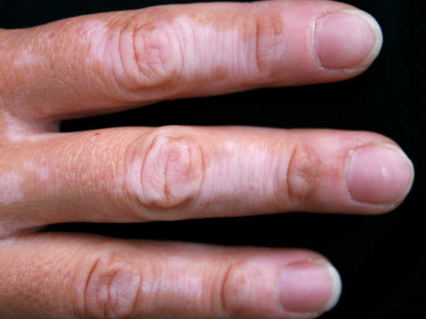 Home Remedies For White Patches Home Remedies For White Patches