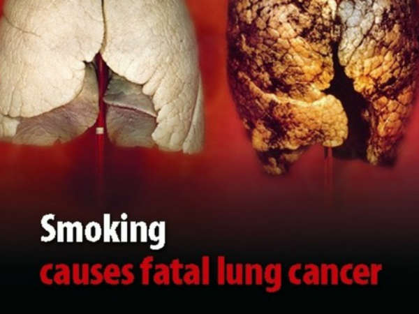 ಕರುಳಿನ ಕ್ಯಾನ್ಸರ್