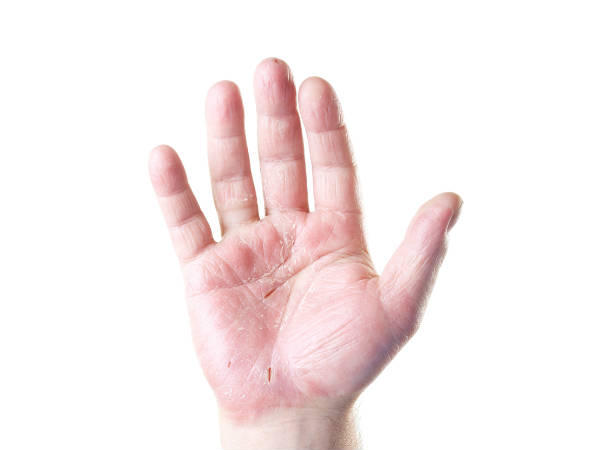 ಇಸಬು, ಚರ್ಮದ ಉರಿಯೂತ(Eczema)