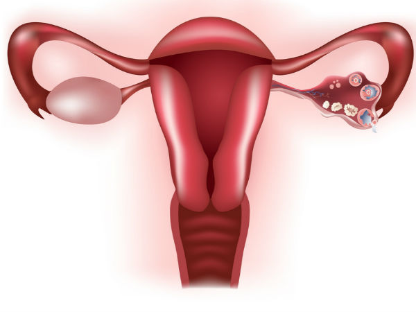  ಗರ್ಭಕೋಶದಲ್ಲಿ ತೊಂದರೆ