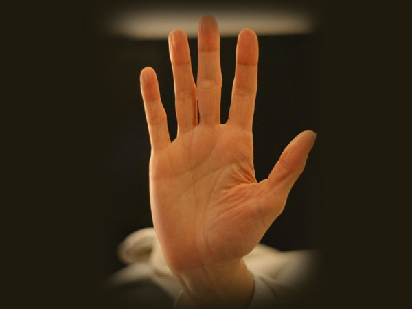 ಅಂಗೈಯಲ್ಲಿ ಮಚ್ಚೆ