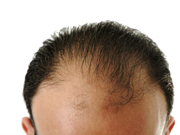 Alopecia Areata
