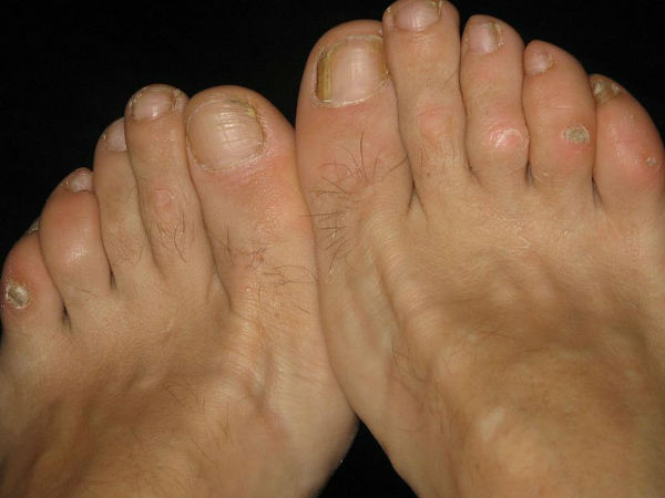 ನರಹುಲಿ(warts) ವಿರುದ್ಧ ಪರಿಣಾಮಕಾರಿ