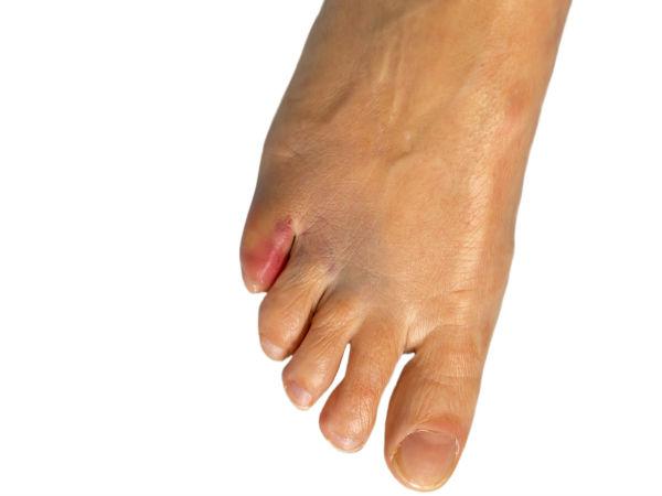 ಕಾಲುಗಳ ಮೇಲೆ ಪ್ರಭಾವ