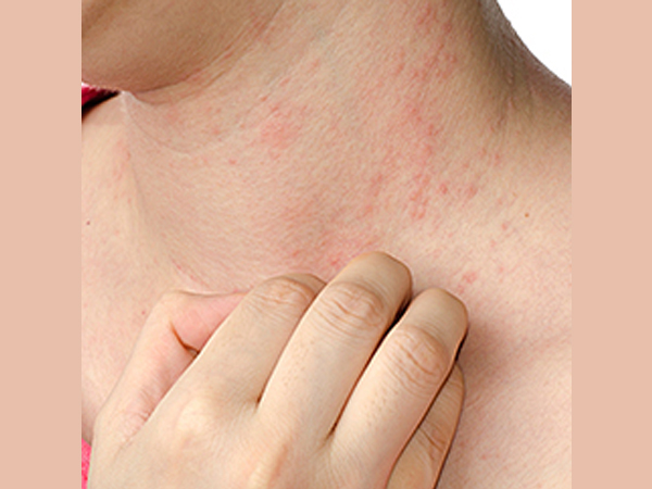 ಚರ್ಮದಲ್ಲಿ ತುರಿಕೆ, ಚರ್ಮಸಂಬಂಧಿ ರೋಗಗಳು ಎದುರಾಗಬಹುದು