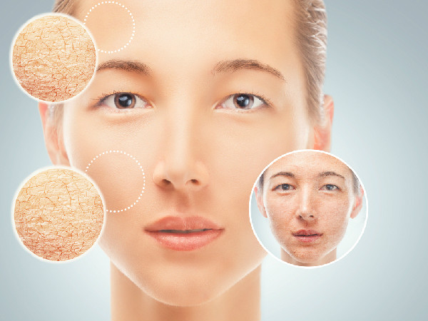 ಮಳೆಗಾಲದಲ್ಲಿ ಒಣ ತ್ವಚೆ ಕಂಡುಬಂದರೆ