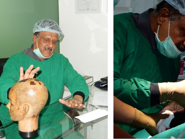 Successful Bifollicular Hair Transplant by Hairline International 