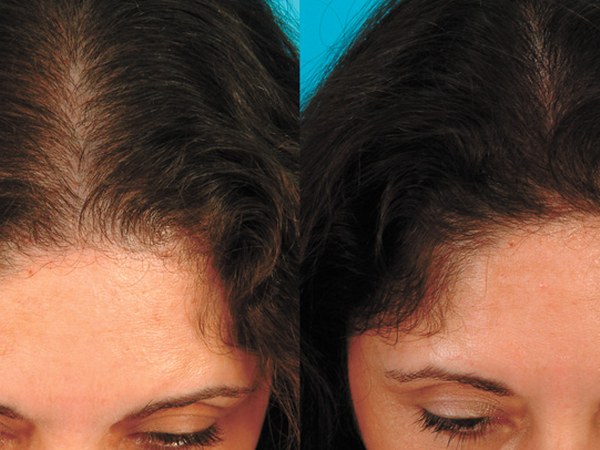 Hairline International Launches, Vampire Hair Growth treatment in India