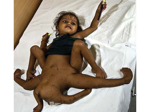 ಎಂಟು ಕಾಲುಗಳ ಬಾಲಕಿ