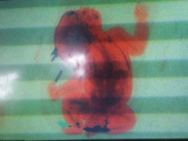 ಬೆನ್ನಿನ ಚೀಲದಲ್ಲಿ ಮಗುವನ್ನು ಸಾಗಿಸಲು ಯತ್ನಿಸಿದ ಅಮ್ಮ!