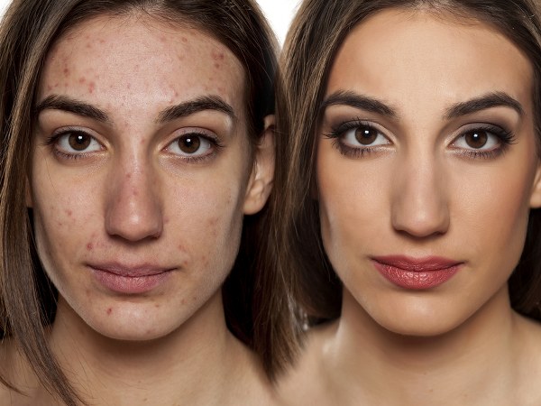 ಮುಖದ ಮೊಡವೆಗಳನ್ನು ನಿವಾರಿಸುತ್ತದೆ