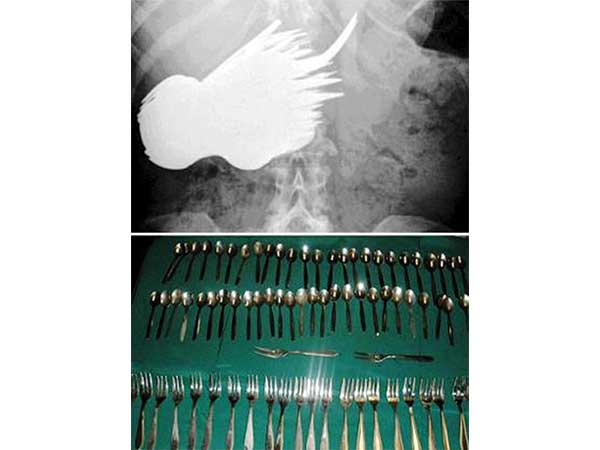 ಹೊಟ್ಟೆಯಲ್ಲಿ ಚಮಚ..! 