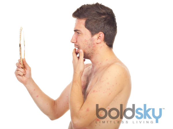 How Is Neem Used On Skin For Chickenpox? 