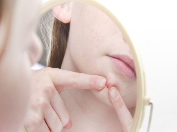 Here’s why you frequently get acne on the chin and T-zone Here’s why you frequently get acne on the chin and T-zone