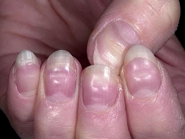 Ways to Get Rid of Stained Nails