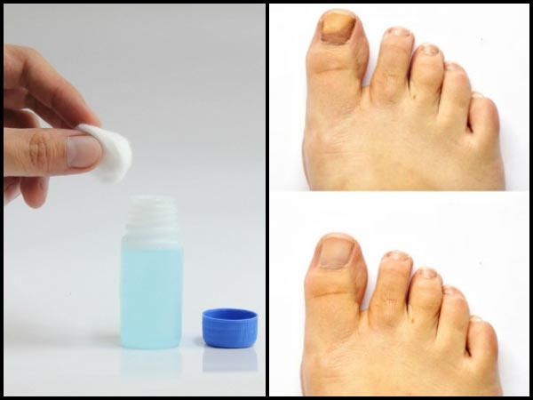 ಕಾಲುಬೆರಳುಗಳ ಉಗುರಿನ ಸಂದುಗಳ ಸೋಂಕನ್ನು ನಿವಾರಿಸುತ್ತದೆ