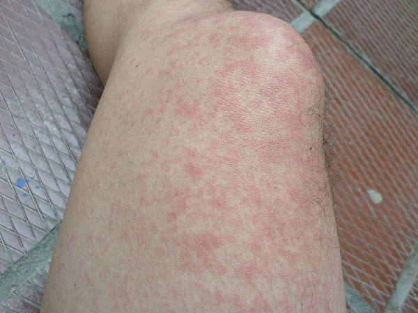 ಚರ್ಮ ಕೆಂಪಗಾಗುತ್ತದೆ