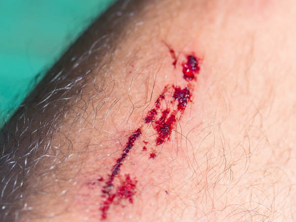 ಹಾವು ಕಚ್ಚಿದ ಸಂದರ್ಭದಲ್ಲಿ ಮೊದಲು ಮಾಡುವ ಕೆಲಸ