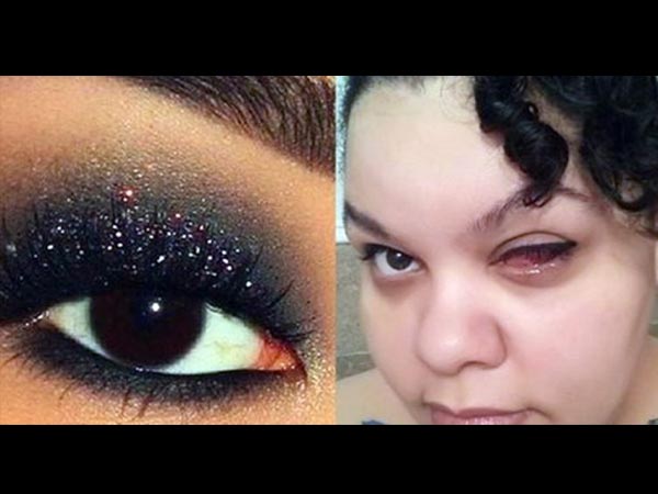 ಕಡೆಗೆ ಆಕೆ ಕಣ್ಣನ್ನೇ ಕಳೆದುಕೊಳ್ಳಬೇಕಾಯಿತು