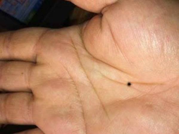 ಎಡ ಹಸ್ತದ ಮೇಲೆ ಇರುವ ಮಚ್ಚೆ