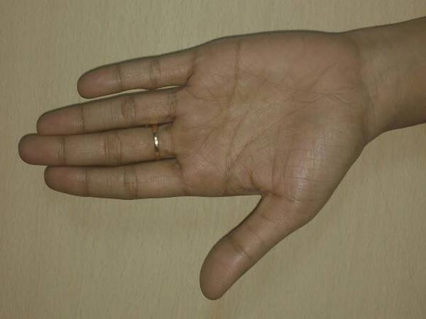 ಕಿರುಬೆರಳ ಬುಡ ಇತರ ಬೆರಳುಗಳಿಗಿಂತ ಕೆಳಗಿದ್ದರೆ