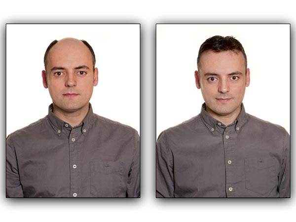 ಕೂದಲು ಉದುರುವುದಕ್ಕೆ