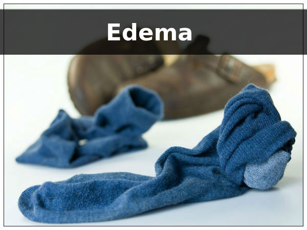 ಎಡಿಮಾದ ಅಪಾಯವಿದೆಯಾ? ಎಡಿಮಾದ ಅಪಾಯವಿದೆಯಾ?