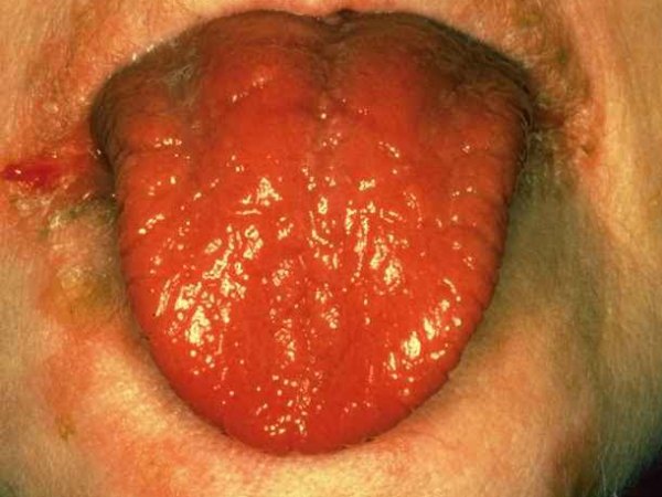 ಊದಿಕೊಂಡ ನಾಲಿಗೆ ಊದಿಕೊಂಡ ನಾಲಿಗೆ