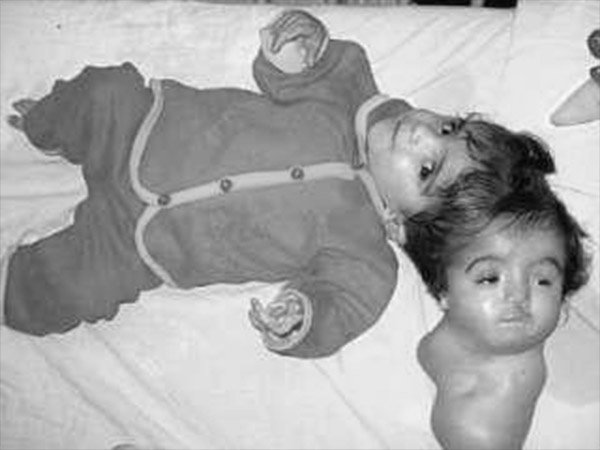 ತಲೆಗಳು ಜೊತೆಯಾದ ಮಗು