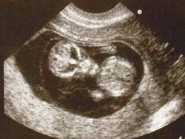 ಚಿತ್ರ#1 ಅನ್ಯಗ್ರಹದ ಮಗುವೇ ಇದು?