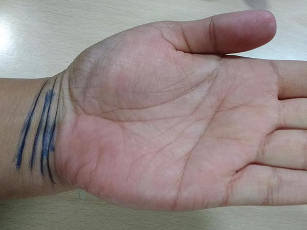 ಕಂಕಣ ರೇಖೆಗಳು 