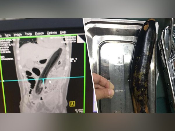 ಹೊಟ್ಟೆಯೊಳಗೆ ಗಾಯ ಮಾಡಿಕೊಂಡ