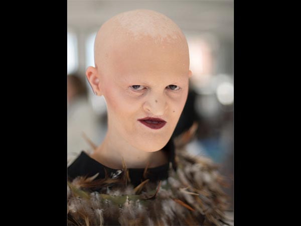 model with genetic disorder model with genetic disorder