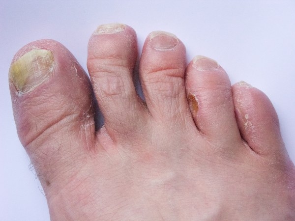 ಉಗುರಿನ ಶಿಲೀಂಧ್ರದ ಸೋಂಕಿಗೆ ಕಾರಣಗಳೇನು?