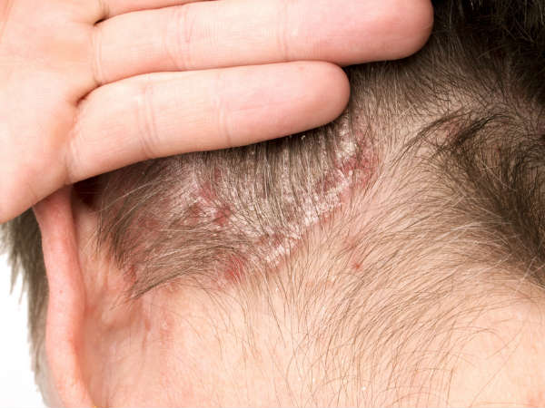 ತಲೆಬುರುಡೆಯ ಬೊಕ್ಕೆ ನಿವಾರಣೆಗೆ