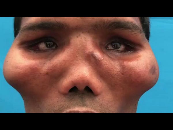 ಮುಖವು ಊದಿಕೊಂಡಿತ್ತು