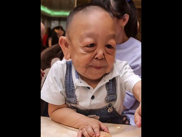 ಈ ಕಾಯಿಲೆಯ ಆರಂಭಿಕ ಲಕ್ಷಣಗಳು…