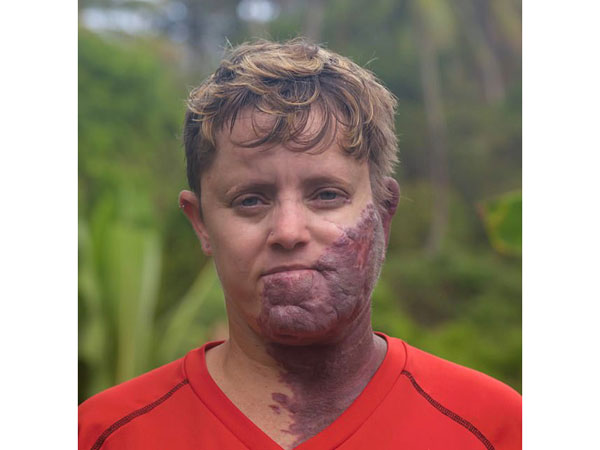 ಈ ಜನ್ಮಗುರುತು ದೊಡ್ಡದಾಗಿರುವುದು