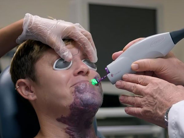 ಆಕೆ ಲೇಸರ್ ಚಿಕಿತ್ಸೆಗೆ ಒಳಗಾದಳು