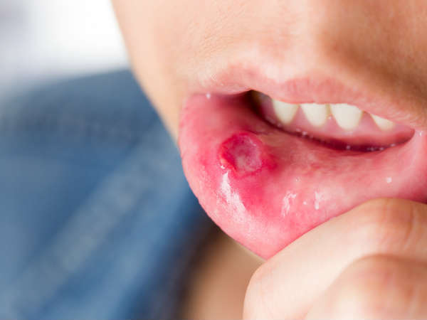 Lip Cancer Lip Cancer