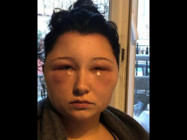 Woman’s Head Expanded After She Used Hair Dye