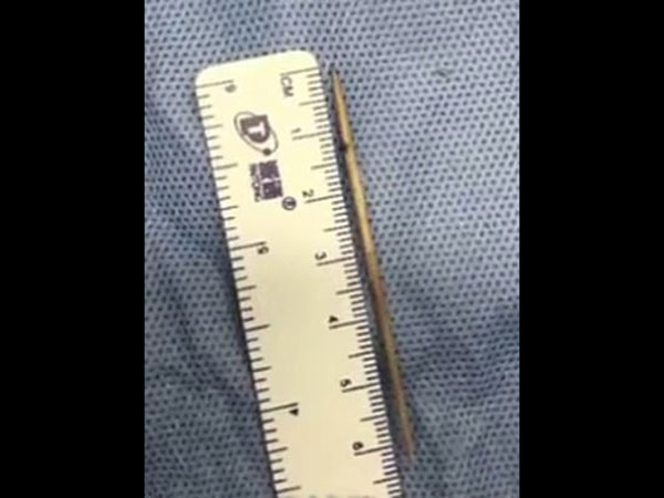 ಎದೆಯಲ್ಲಿ ನೋವು ಕಾಣಿಸಿಕೊಂಡ ವೇಳೆ ವೈದ್ಯರು ಶಸ್ತ್ರಚಿಕಿತ್ಸೆ ನಡೆಸಿದರು ಎದೆಯಲ್ಲಿ ನೋವು ಕಾಣಿಸಿಕೊಂಡ ವೇಳೆ ವೈದ್ಯರು ಶಸ್ತ್ರಚಿಕಿತ್ಸೆ ನಡೆಸಿದರು