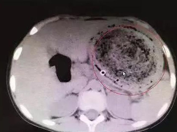 ಕೂದಲು ತಿನ್ನದಂತೆ ಆಕೆಯ ತಾಯಿಯು ಆಕೆಗೆ ಸೂಚಿಸಿದ್ದರು ಕೂದಲು ತಿನ್ನದಂತೆ ಆಕೆಯ ತಾಯಿಯು ಆಕೆಗೆ ಸೂಚಿಸಿದ್ದರು