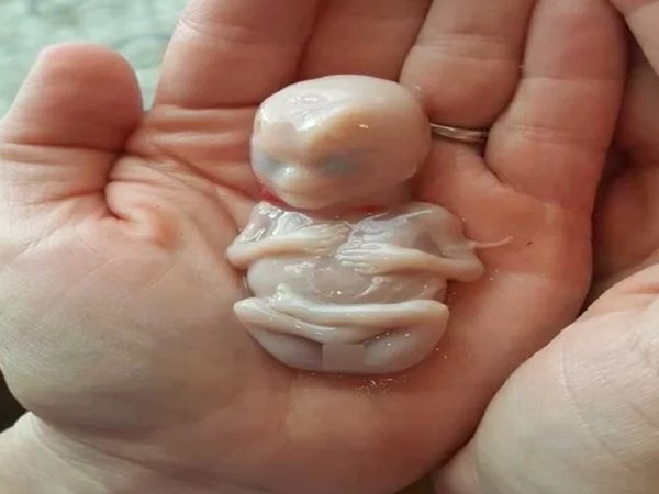 ದಂಪತಿಯು ಈ ಭ್ರೂಣವನ್ನು ಒಂದು ಕುಂಡದಲ್ಲಿ ದಫನ ಮಾಡಲು ನಿರ್ಧರಿಸಿದರು