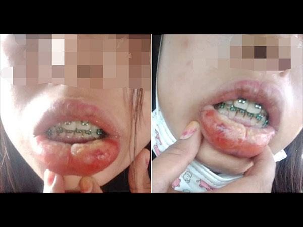 Fake Braces Fake Braces