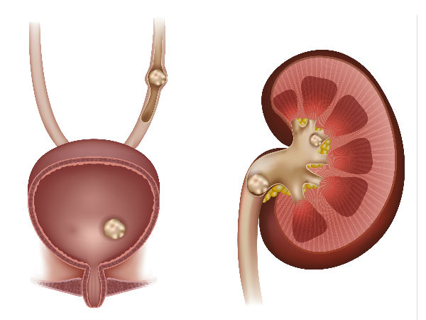 Kidney Cancer Kidney Cancer