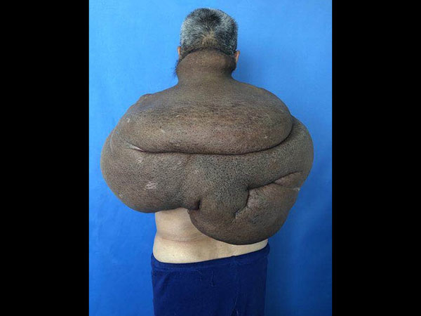 30 ವರ್ಷಗಳಿಂದ ಅವರು ಇದರೊಂದಿಗೆ ಬದುಕುತ್ತಿದ್ದಾರೆ